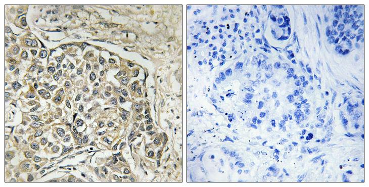 ARSD / Arylsulfatase D Antibody - Peptide - + Immunohistochemistry analysis of paraffin-embedded human lung carcinoma tissue using ARSD antibody.