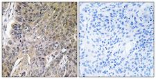 ARSG / Arylsulfatase G Antibody - Immunohistochemistry analysis of paraffin-embedded human lung carcinoma tissue, using ARSG Antibody. The picture on the right is blocked with the synthesized peptide.
