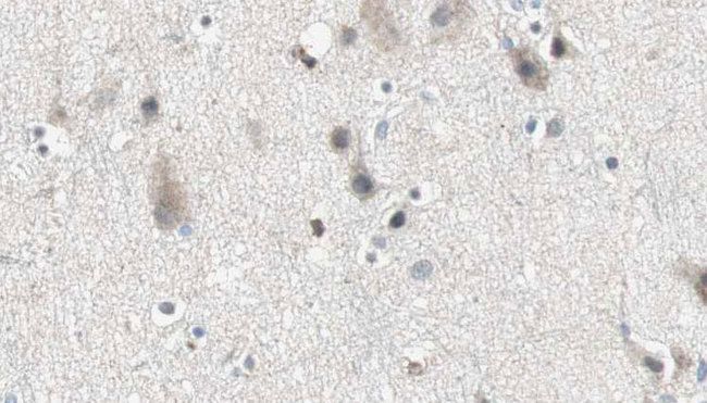 ARSG / Arylsulfatase G Antibody - 1:100 staining human brain carcinoma tissue by IHC-P. The sample was formaldehyde fixed and a heat mediated antigen retrieval step in citrate buffer was performed. The sample was then blocked and incubated with the antibody for 1.5 hours at 22°C. An HRP conjugated goat anti-rabbit antibody was used as the secondary.