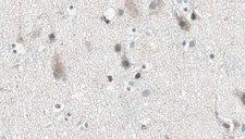 ARSG / Arylsulfatase G Antibody - 1:100 staining human brain carcinoma tissue by IHC-P. The sample was formaldehyde fixed and a heat mediated antigen retrieval step in citrate buffer was performed. The sample was then blocked and incubated with the antibody for 1.5 hours at 22°C. An HRP conjugated goat anti-rabbit antibody was used as the secondary.