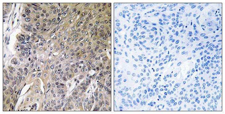 ARSG / Arylsulfatase G Antibody - Peptide - + Immunohistochemistry analysis of paraffin-embedded human lung carcinoma tissue, using ARSG antibody.