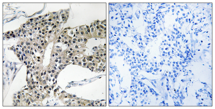 ARSK / Arylsulfatase K Antibody - Immunohistochemistry analysis of paraffin-embedded human breast carcinoma tissue, using ARSK Antibody. The picture on the right is blocked with the synthesized peptide.