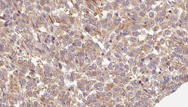 ARSK / Arylsulfatase K Antibody - 1:100 staining human Melanoma tissue by IHC-P. The sample was formaldehyde fixed and a heat mediated antigen retrieval step in citrate buffer was performed. The sample was then blocked and incubated with the antibody for 1.5 hours at 22°C. An HRP conjugated goat anti-rabbit antibody was used as the secondary.