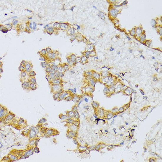 ART1 /CD296 Antibody - Immunohistochemistry of paraffin-embedded Human lung cancer using ART1 Polyclonal Antibody at dilution of 1:100 (40x lens).