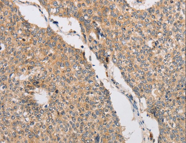 ART3 Antibody - Immunohistochemistry of paraffin-embedded Human lung cancer using ART3 Polyclonal Antibody at dilution of 1:40.