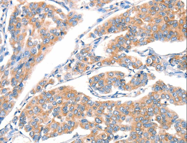 ART4 Antibody - Immunohistochemistry of paraffin-embedded Human breast cancer using ART4 Polyclonal Antibody at dilution of 1:30.