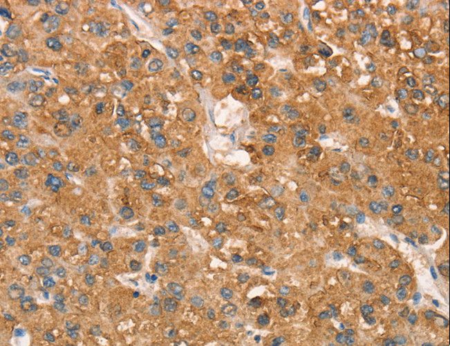 ART4 Antibody - Immunohistochemistry of paraffin-embedded Human liver cancer using ART4 Polyclonal Antibody at dilution of 1:50.