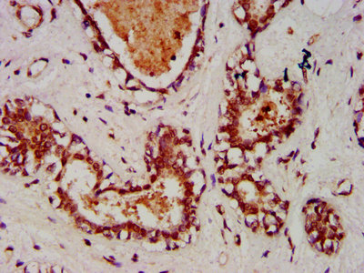 ART5 Antibody - IHC image of ART5 Antibody diluted at 1:1000 and staining in paraffin-embedded human breast cancer performed on a Leica BondTM system. After dewaxing and hydration, antigen retrieval was mediated by high pressure in a citrate buffer (pH 6.0). Section was blocked with 10% normal goat serum 30min at RT. Then primary antibody (1% BSA) was incubated at 4°C overnight. The primary is detected by a biotinylated secondary antibody and visualized using an HRP conjugated SP system.
