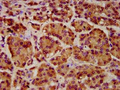 ART5 Antibody - IHC image of ART5 Antibody diluted at 1:1000 and staining in paraffin-embedded human pancreatic cancer performed on a Leica BondTM system. After dewaxing and hydration, antigen retrieval was mediated by high pressure in a citrate buffer (pH 6.0). Section was blocked with 10% normal goat serum 30min at RT. Then primary antibody (1% BSA) was incubated at 4°C overnight. The primary is detected by a biotinylated secondary antibody and visualized using an HRP conjugated SP system.