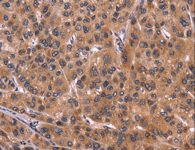 ART5 Antibody - Immunohistochemistry of paraffin-embedded Human liver cancer using ART5 Polyclonal Antibody at dilution of 1:50.