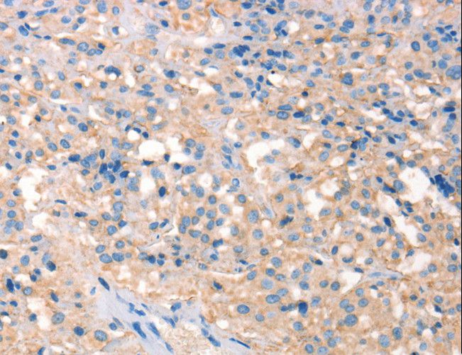 ARTS Antibody - Immunohistochemistry of paraffin-embedded Human thyroid cancer using PRPS1/2/1L1 Polyclonal Antibody at dilution of 1:30.