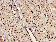 ARTS1 / ERAP1 Antibody - Immunohistochemistry image of paraffin-embedded human endometrial cancer at a dilution of 1:100
