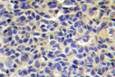 ARTS1 / ERAP1 Antibody - IHC of ERAP1 (K467) pAb in paraffin-embedded human breast carcinoma tissue.