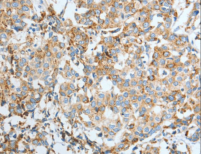 ASAH1 / Acid Ceramidase Antibody - Immunohistochemistry of paraffin-embedded Human breast cancer using ASAH1 Polyclonal Antibody at dilution of 1:50.