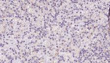 ASAH1 / Acid Ceramidase Antibody - 1:100 staining human lymph carcinoma tissue by IHC-P. The sample was formaldehyde fixed and a heat mediated antigen retrieval step in citrate buffer was performed. The sample was then blocked and incubated with the antibody for 1.5 hours at 22°C. An HRP conjugated goat anti-rabbit antibody was used as the secondary.