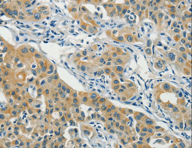 ASAH2 Antibody - Immunohistochemistry of paraffin-embedded Human lung cancer using ASAH2 Polyclonal Antibody at dilution of 1:40.