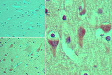 ASAP3 Antibody - IHC ofASAP3 in formalin-fixed, paraffin-embedded human brain tissue using an isotype control (top left) and Polyclonal Antibody to ASAP3 (bottom left, right) at 5 ug/ml.