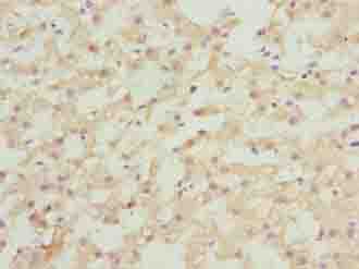 ASAP3 Antibody - Immunohistochemistry of paraffin-embedded human liver cancer using antibody at dilution of 1:100.