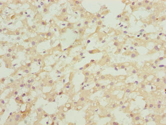 ASAP3 Antibody - Immunohistochemistry of paraffin-embedded human liver cancer using ASAP3 Antibody at dilution of 1:100