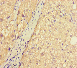 ASB10 Antibody - Immunohistochemistry of paraffin-embedded human liver cancer using ASB10 Antibody at dilution of 1:100