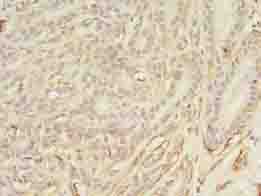 ASB11 Antibody - Immunohistochemistry of paraffin-embedded human breast cancer using antibody at dilution of 1:100.