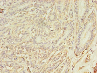 ASB11 Antibody - Immunohistochemistry of paraffin-embedded human breast cancer using ASB11 Antibody at dilution of 1:100