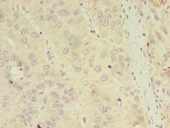 ASB11 Antibody - Immunohistochemistry of paraffin-embedded human liver cancer using ASB11 Antibody at dilution of 1:100