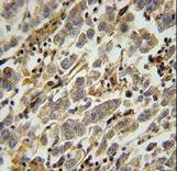ASB17 Antibody - ASB17 Antibody immunohistochemistry of formalin-fixed and paraffin-embedded human testis carcinoma followed by peroxidase-conjugated secondary antibody and DAB staining.