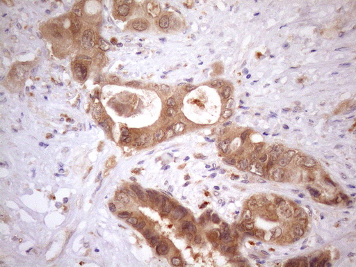 ASB2 Antibody - Immunohistochemical staining of paraffin-embedded Adenocarcinoma of Human colon tissue using anti-ASB2 mouse monoclonal antibody. (Heat-induced epitope retrieval by Tris-EDTA, pH8.0)(1:150)