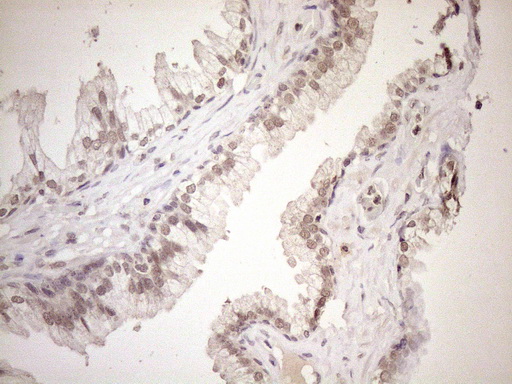 ASB2 Antibody - Immunohistochemical staining of paraffin-embedded Carcinoma of Human prostate tissue using anti-ASB2 mouse monoclonal antibody. (Heat-induced epitope retrieval by 1mM EDTA in 10mM Tris buffer. (pH8.5) at 120°C for 3 min. (1:150)