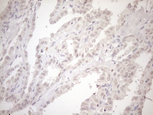 ASB2 Antibody - Immunohistochemical staining of paraffin-embedded Carcinoma of Human thyroid tissue using anti-ASB2 mouse monoclonal antibody. (Heat-induced epitope retrieval by 1mM EDTA in 10mM Tris buffer. (pH8.5) at 120°C for 3 min. (1:150)