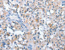 ASB2 Antibody - Immunohistochemistry of paraffin-embedded Human thyroid cancer using ASB2 Polyclonal Antibody at dilution of 1:50.
