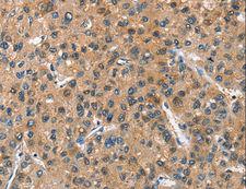 ASB2 Antibody - Immunohistochemistry of paraffin-embedded Human thyroid cancer using ASB2 Polyclonal Antibody at dilution of 1:40.