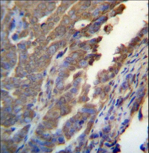 ASB4 Antibody - ASB4 Antibody immunohistochemistry of formalin-fixed and paraffin-embedded human ovarian carcinoma followed by peroxidase-conjugated secondary antibody and DAB staining.