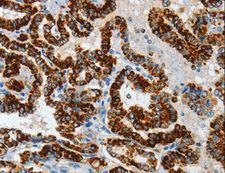 ASB4 Antibody - Immunohistochemistry of paraffin-embedded Human thyroid cancer using ASB4 Polyclonal Antibody at dilution of 1:40.