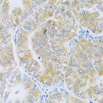 ASB4 Antibody - Immunohistochemistry of paraffin-embedded Human uterine cancer using ASB4 Polyclonal Antibody at dilution of 1:100 (40x lens).