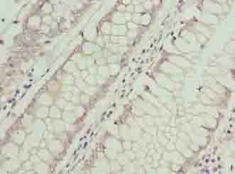 ASB7 Antibody - Immunohistochemistry of paraffin-embedded human colon cancer using antibody at dilution of 1:100.