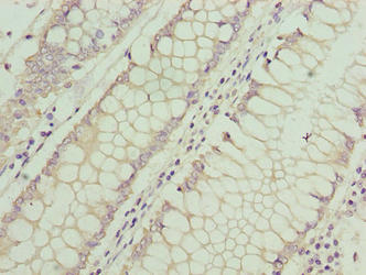 ASB7 Antibody - Immunohistochemistry of paraffin-embedded human colon cancer using ASB7 Antibody at dilution of 1:100