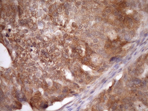 ASB8 Antibody - Immunohistochemical staining of paraffin-embedded Carcinoma of Human liver tissue using anti-ASB8 mouse monoclonal antibody. (Heat-induced epitope retrieval by Tris-EDTA, pH8.0)(1:150)