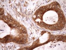 ASB8 Antibody - IHC of paraffin-embedded Adenocarcinoma of Human colon tissue using anti-ASB8 mouse monoclonal antibody. (Heat-induced epitope retrieval by Tris-EDTA, pH8.0)(1:150).