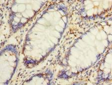 ASB8 Antibody - Immunohistochemistry of paraffin-embedded human colon cancer using antibody at dilution of 1:100.