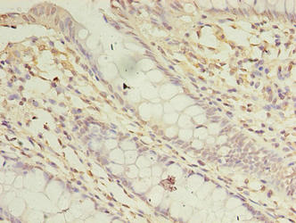 ASB8 Antibody - Immunohistochemistry of paraffin-embedded human colon cancer using ASB8 Antibody at dilution of 1:100