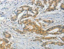 ASB8 Antibody - Immunohistochemistry of paraffin-embedded Human colon cancer using ASB8 Polyclonal Antibody at dilution of 1:50.