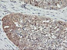 ASCC1 Antibody - IHC of paraffin-embedded Adenocarcinoma of Human ovary tissue using anti-ASCC1 mouse monoclonal antibody.