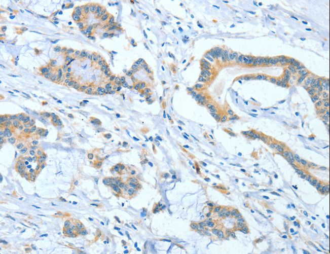 ASCC1 Antibody - Immunohistochemistry of paraffin-embedded Human colon cancer using ASCC1 Polyclonal Antibody at dilution of 1:50.