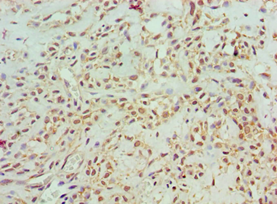 ASCC3 Antibody - Immunohistochemistry of paraffin-embedded human breast cancer using antibody at 1:100 dilution.