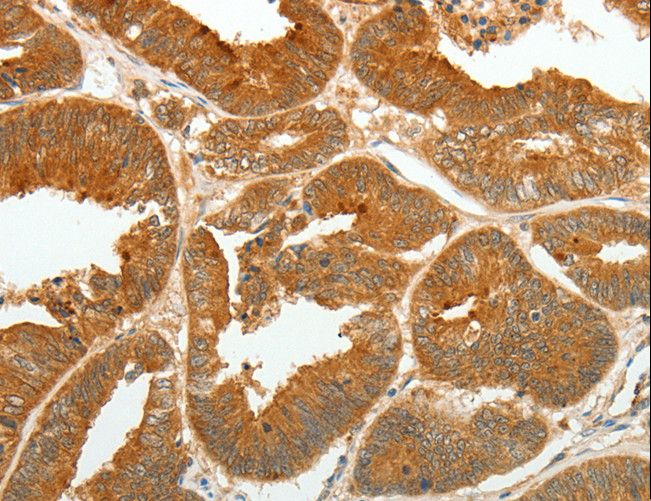 ASCL1 / MASH1 Antibody - Immunohistochemistry of paraffin-embedded Human lung cancer using ASCL1 Polyclonal Antibody at dilution of 1:30.