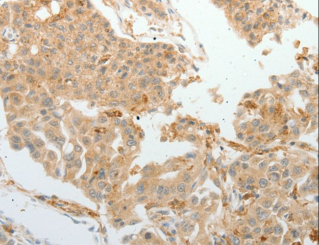 ASCL1 / MASH1 Antibody - Immunohistochemistry of paraffin-embedded Human lung cancer using ASCL1 Polyclonal Antibody at dilution of 1:30.