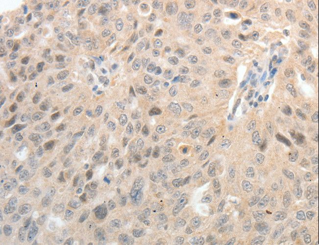 ASCL1 / MASH1 Antibody - Immunohistochemistry of paraffin-embedded Human thyroid cancer using ASCL1 Polyclonal Antibody at dilution of 1:30.