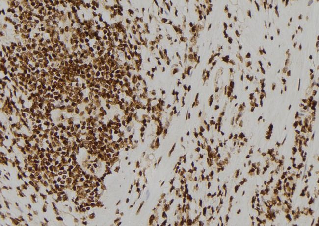 ASCL1 / MASH1 Antibody - 1:100 staining human gastric tissue by IHC-P. The sample was formaldehyde fixed and a heat mediated antigen retrieval step in citrate buffer was performed. The sample was then blocked and incubated with the antibody for 1.5 hours at 22°C. An HRP conjugated goat anti-rabbit antibody was used as the secondary.
